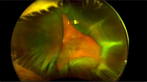 Choroidal Detachment - Retina Image Bank