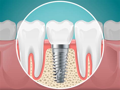 Benefits And Risks Of Dental Implants | Wilsonville Dental Group