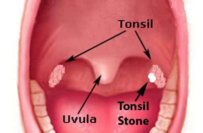 Tonsil Stones - Pictures, Symptoms, Causes, Prevention, Removal ...