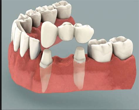 Dental Bridge Problems | SouthPointe Dental | Lincoln, NE