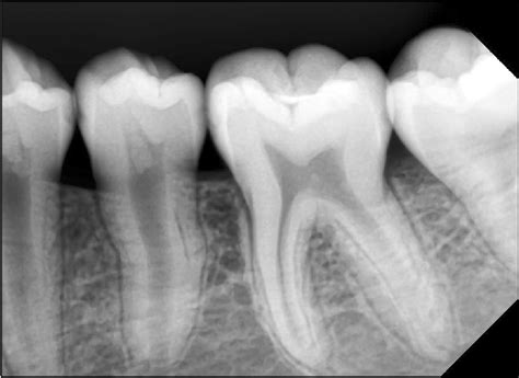 Mandibular Periapical Radiograph