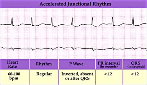 Accelerated Junctional Rhythm | Paramedic Study Guide | Pinterest ...