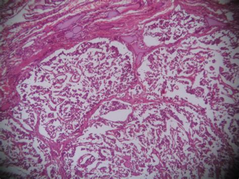 MEDULLARY CARCINOMA – THYROID – Histopathology.guru