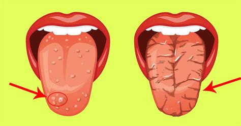 White Bump On Tongue Cause