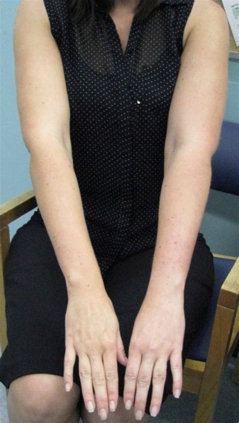 Subtle arm swelling and discoloration associated with subclavian ...