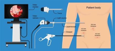 It Hurts to Eat After Endoscopy? Complications and What to Eat