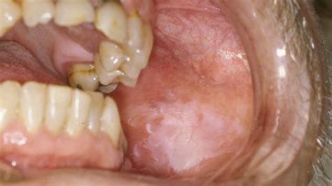 Mouth Sores: Pictures, Causes, Types, Symptoms, and Treatments