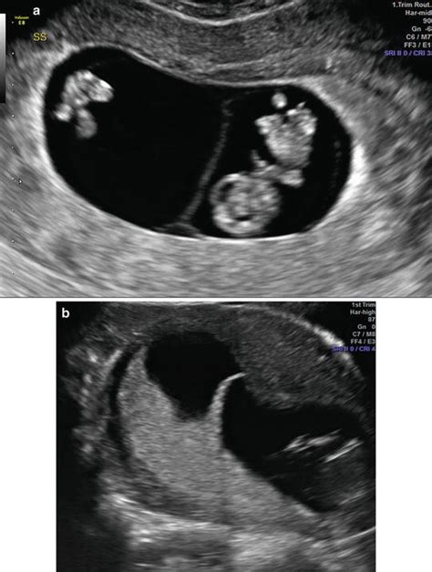 First-Trimester Ultrasound: Guidelines | Radiology Key