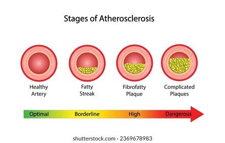 105 Atherosclerosis Development Images, Stock Photos, 3D objects, & Vectors | Shutterstock