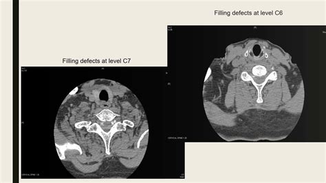 CT Cervical Myelogram - YouTube