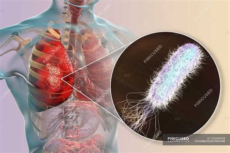 Pseudomonas Aeruginosa Disease Caused - Carpet Vidalondon