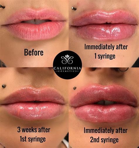 Pin by Phillipa Riddle on Fillers | Lip injections juvederm, Lip ...