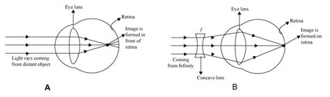 Explain with the help of a labelled ray diagram the defect of myopia and how it is corrected.