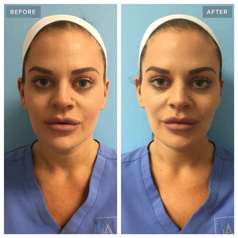 Thread Lift | FAQs + Before & After | Injectable Aesthetics