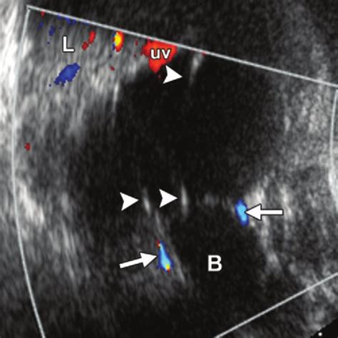 Ovarian cyst with a single septation. Axial fetal US image shows a ...