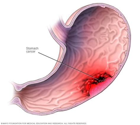 Cáncer de estomago - Mind Map