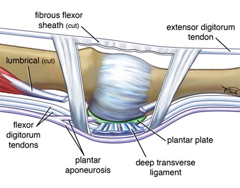 Plantar Plate Tears - Queensland Orthotic Lab