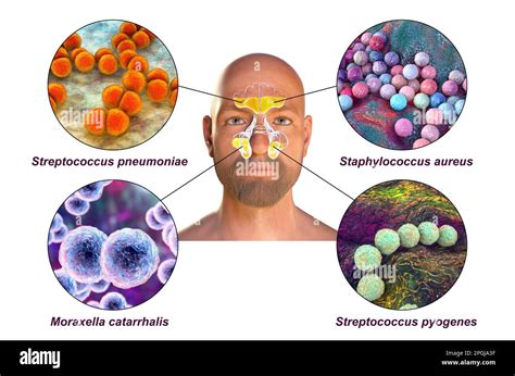 Anatomy Of Rhinosinusitis And Bacteria That Cause Sinusitis Illustration Stock Photo Download ...