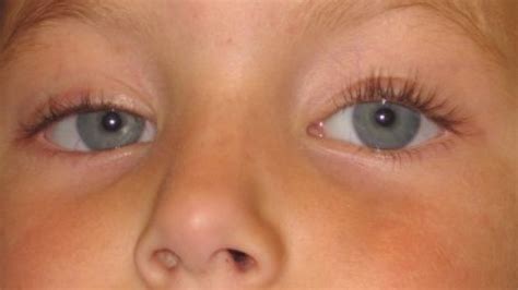 Congenital Ptosis Boise | Drooping Eyelid Idaho