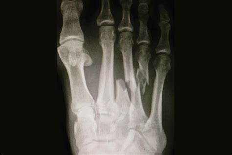 The Lisfranc Tear: Examining Kelly Slater’s Extreme Foot Injury