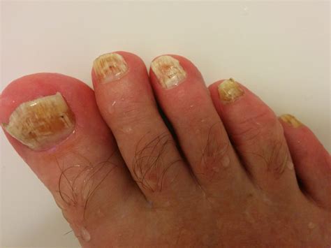 Fungus on both feet, left and right – Toenail Fungus