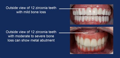 Bionic Smile Full Arch Implants