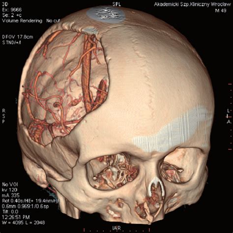 Status post an extensive right-sided craniectomy, VR reconstruction. | Download Scientific Diagram