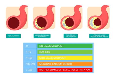 Coronary Calcium Score - Capital Heart Centre