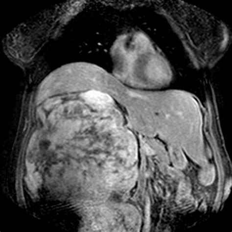 Retroperitoneal Liposarcoma - Body MR Case Studies - CTisus CT Scanning