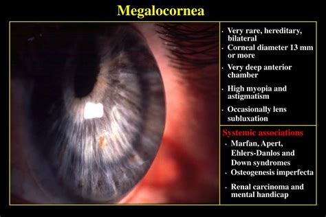 PPT - 1. Microcornea PowerPoint Presentation, free download - ID:1403620