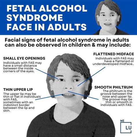 Fetal Alcohol Syndrome In Adults Symptoms, Facial Signs