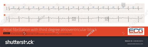 Cardiac Surgery One Common Causes Iatrogenic Stock Illustration ...