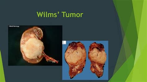 Wilms tumor | PPT