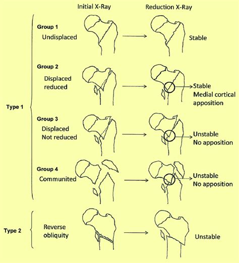 Evans classification of intertrochanteric fractures. | Download ...