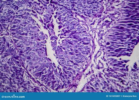 Bladder Transitional Cell Carcinoma, Light Micrograph Stock Image - Image of cancer, carcinoma ...