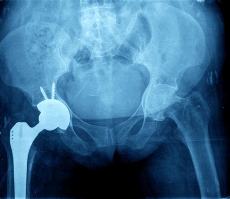 Hip Replacement: Types of Surgeries