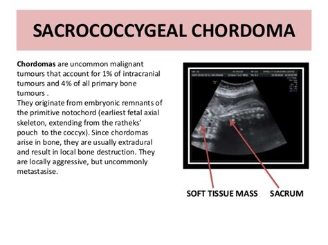 Chordoma