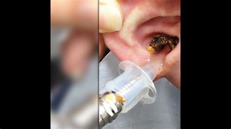 ear wax impaction is an obstruction of the ear canal with wax cerumen ...