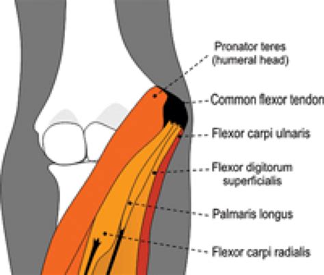 Common Flexor Tendon Tear