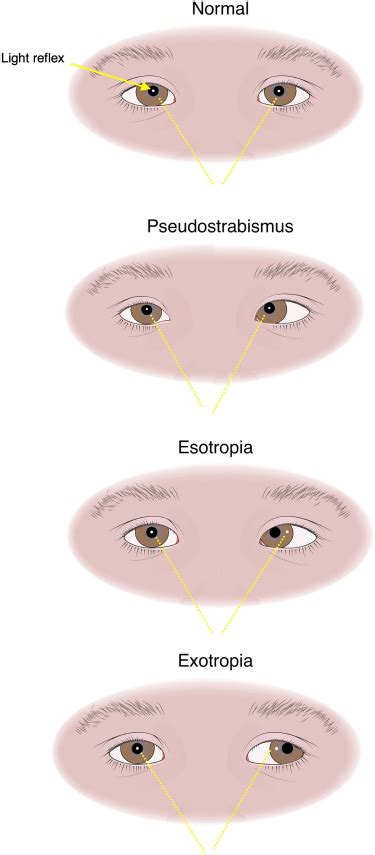 Evaluating Eye Crossing Using the Corneal Light Reflex - The Journal of Pediatrics