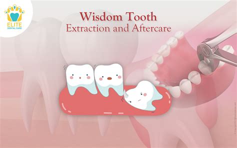 07 Wisdom Tooth Extraction and Aftercare | Elite Dental Care