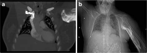 CT contrast media extravasation - WikEM