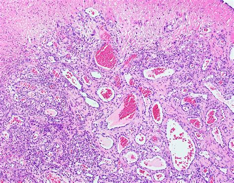 Oral Pyogenic Granuloma Histology