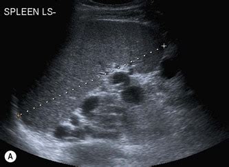 Ultrasound of the spleen and lymphatic system | Radiology Key