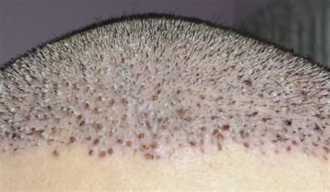 Scabs after hair transplant - DHI Panamá