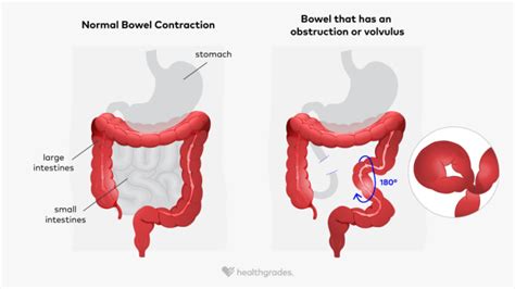 Sigmoid Volvulus: Symptoms, Causes, and Treatment