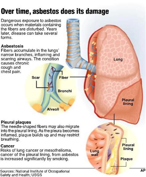 Asbestosis, Cancer Asbestos, Mesothelioma Symptoms, Information - Ain Health