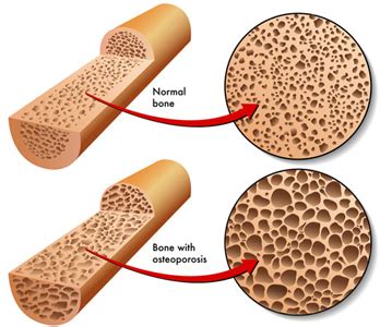 Ayurvedic Treatment of Low Bone Density, Osteopenia, Herbal Remedies