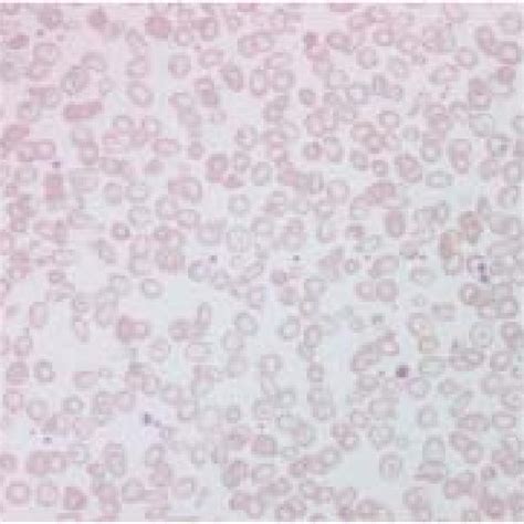 Hemoglobin analysis of Hb H-Hb CS patient showing Hb Bart's, Hb H, Hb ...