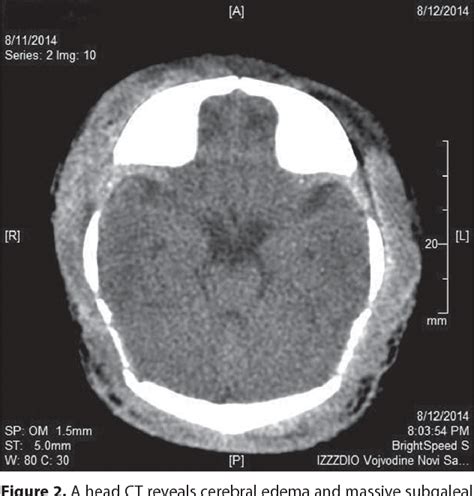 [PDF] Severe neonatal subgaleal hemorrhage as the first presentation of hemophilia A. | Semantic ...